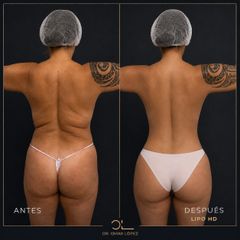 Lipoescultura - Clínica Dr. Omar López
