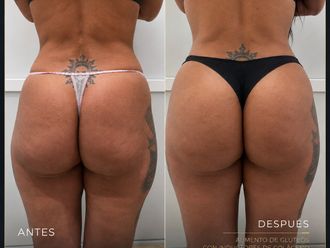 Lipoescultura antes y después - 880993