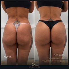 Lipoescultura - Clínica Dr. Omar López