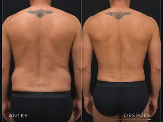 Lipoescultura antes y después - 880994