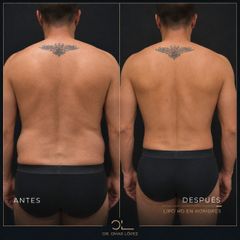 Lipoescultura - Clínica Dr. Omar López