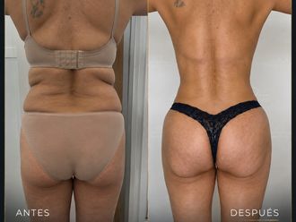 Lipoescultura antes y después - 880995