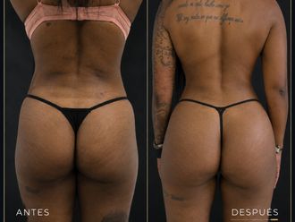 Lipoescultura antes y después - 880996