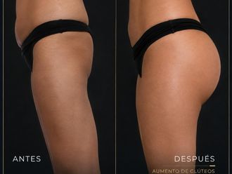 Lipoescultura antes y después - 880997