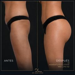 Lipoescultura - Clínica Dr. Omar López