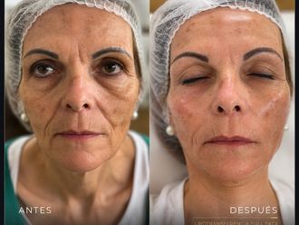 Rejuvenecimiento facial antes y después - 880999