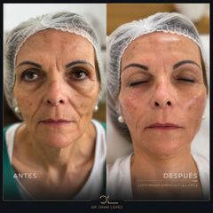 Rejuvenecimiento Facial - Clínica Dr. Omar López