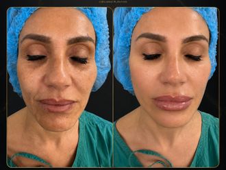 Rejuvenecimiento facial antes y después - 881001