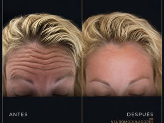 Rejuvenecimiento facial antes y después - 881002