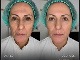 Rejuvenecimiento facial antes y después - 881003
