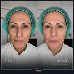 Rejuvenecimiento Facial - Clínica Dr. Omar López