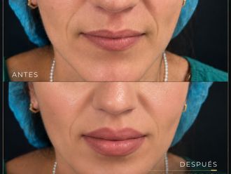 Rejuvenecimiento facial antes y después - 881004