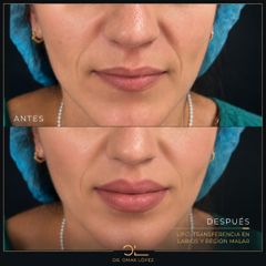 Rejuvenecimiento Facial - Clínica Dr. Omar López
