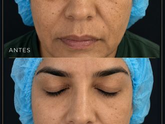 Rejuvenecimiento facial antes y después - 881007