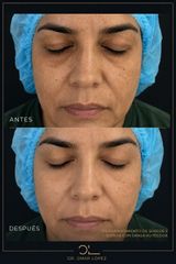 Rejuvenecimiento Facial - Clínica Dr. Omar López