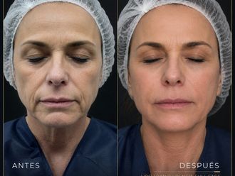 Rejuvenecimiento facial antes y después - 881011