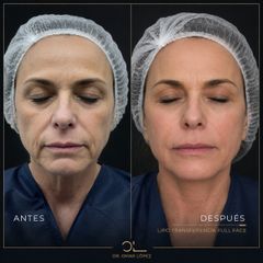 Rejuvenecimiento Facial - Clínica Dr. Omar López