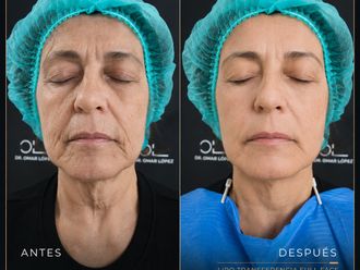 Rejuvenecimiento facial antes y después - 881015