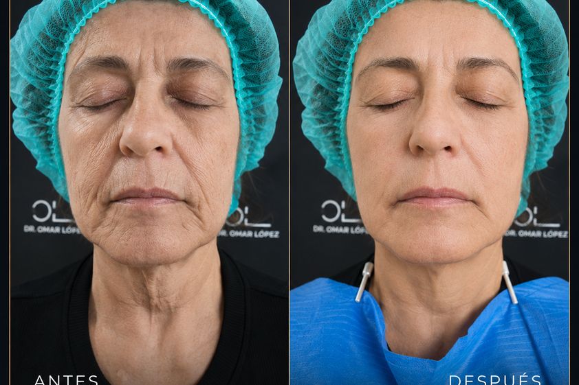 Rejuvenecimiento facial antes y después - 881015