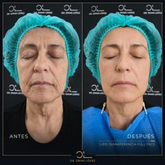 Rejuvenecimiento Facial - Clínica Dr. Omar López