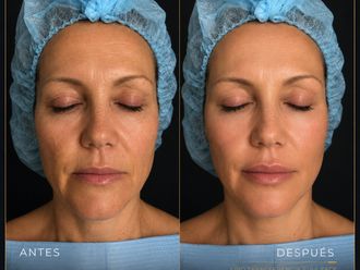 Rejuvenecimiento facial antes y después - 881019