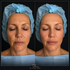 Rejuvenecimiento Facial - Clínica Dr. Omar López