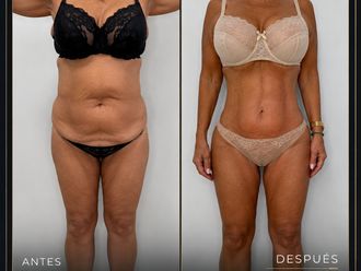 Lipo Vaser antes y después - 881108