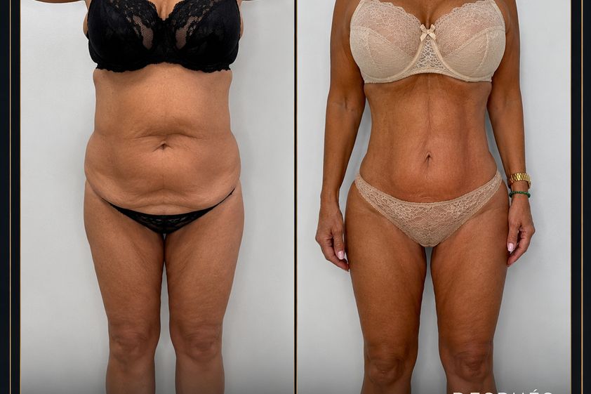 Lipo Vaser antes y después - 881108