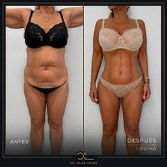 Lipo Vaser - Clínica Dr. Omar López