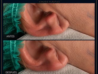Lipofilling antes y después - 881109