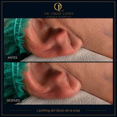 Lipofiling del lóbulo oreja - Clínica Dr. Omar López