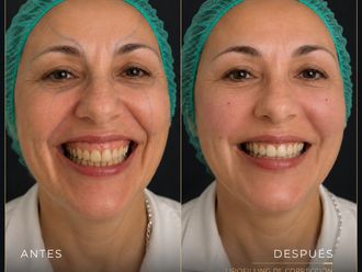 Rejuvenecimiento facial antes y después - 881110