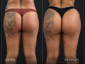 Lipo Vaser antes y después - 881111