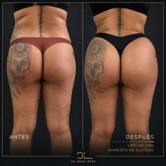 Lipo Vaser - Clínica Dr. Omar López