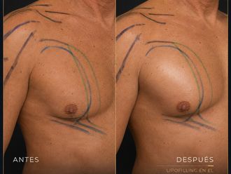 Lipofilling antes y después - 881112