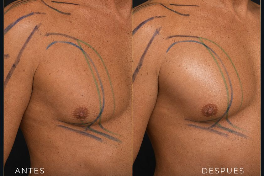 Lipofilling antes y después - 881112