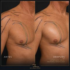 Lipofilling pectoral masculino - Clínica Dr. Omar López
