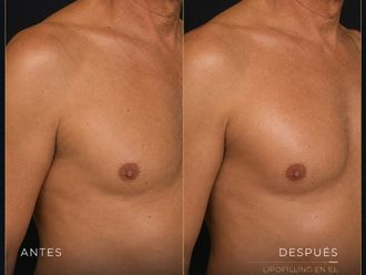 Lipofilling antes y después - 881113