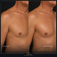 Lipofilling pectoral masculino - Clínica Dr. Omar López