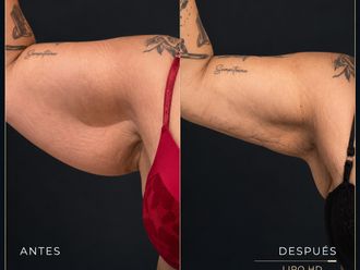 Lipoescultura antes y después - 881155