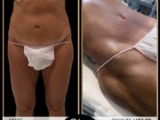 Lipo Vaser antes y después - 881156