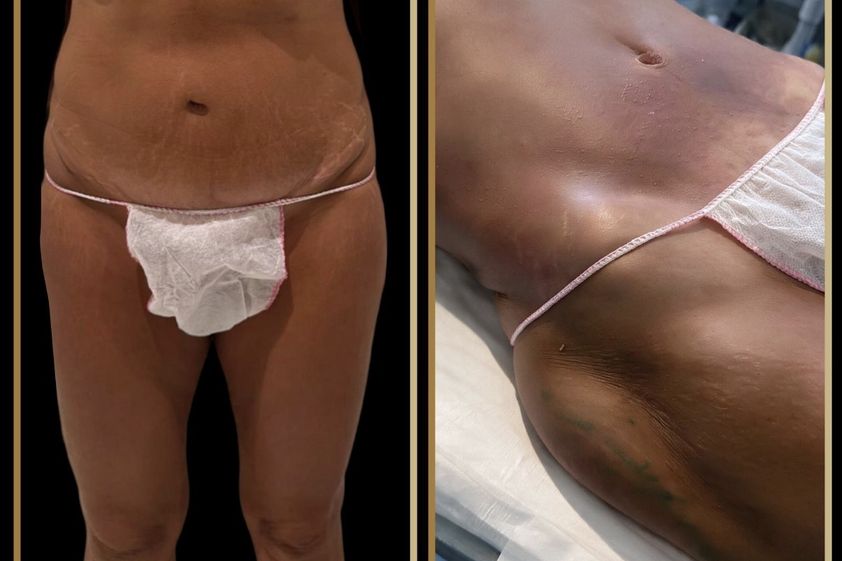 Lipo Vaser antes y después - 881156