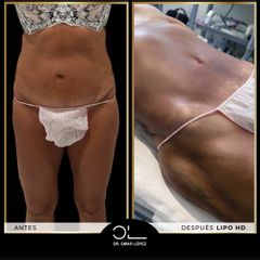 Clínica Dr. Omar López - Lipo Vaser