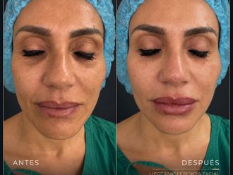 Lipofilling antes y después - 881169