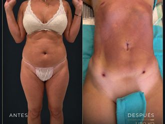 Lipoescultura antes y después - 881248
