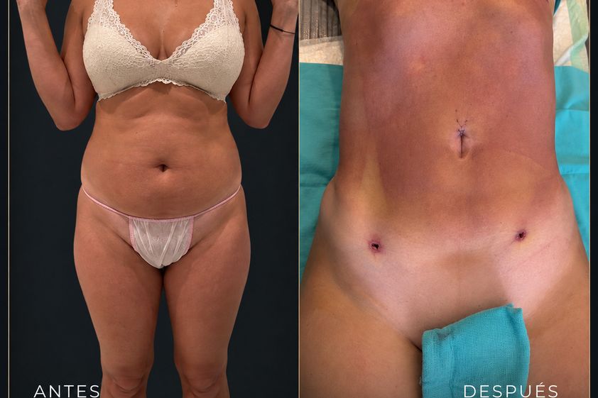 Lipoescultura antes y después - 881248