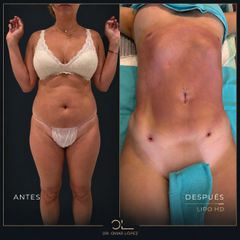 Clínica Dr. Omar López - Lipoescultura