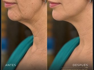 Lipofilling antes y después - 881249