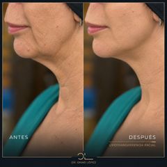 Clínica Dr. Omar López - Lipofilling