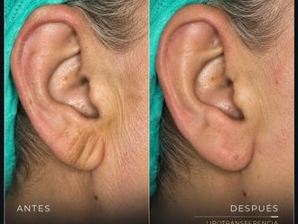 Lipofilling antes y después - 881250